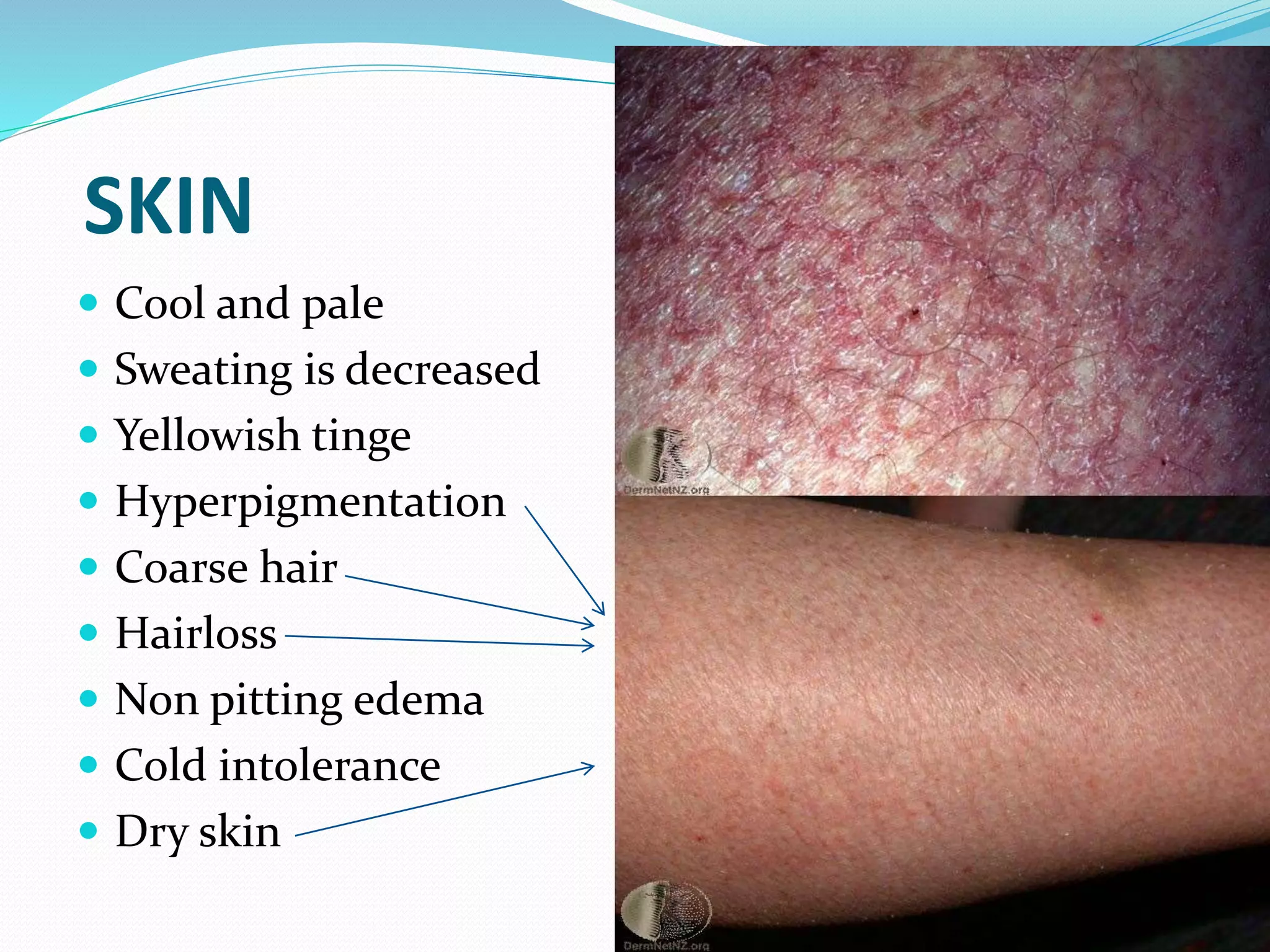 SKIN
 Cool and pale
 Sweating is decreased
 Yellowish tinge
 Hyperpigmentation
 Coarse hair
 Hairloss
 Non pitting edema
 Cold intolerance
 Dry skin
 