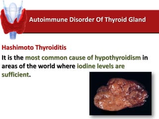 Autoimmune Disorder Of Thyroid Gland
Hashimoto Thyroiditis
It is the most common cause of hypothyroidism in
areas of the world where iodine levels are
sufficient.
 