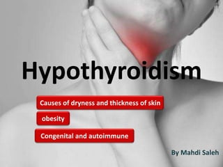 Hypothyroidism
Causes of dryness and thickness of skin
obesity
Congenital and autoimmune
By Mahdi Saleh
 