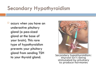Secondary Hypothyroidism
 occurs when you have an
underactive pituitary
gland (a pea-sized
gland at the base of
your brain). This rare
type of hypothyroidism
prevents your pituitary
gland from sending TSH
to your thyroid gland.
 