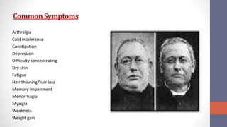 CommonSymptoms
Arthralgia
Cold intolerance
Constipation
Depression
Difficulty concentrating
Dry skin
Fatigue
Hair thinning/hair loss
Memory impairment
Menorrhagia
Myalgia
Weakness
Weight gain
 