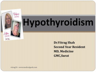 Hypothyroidism
                                 Dr.Vitrag Shah
                                 Second Year Resident
                                 MD, Medicine
                                 GMC,Surat


vitrag24 - www.medicalgeek.com
 
