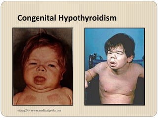 Congenital Hypothyroidism




vitrag24 - www.medicalgeek.com
 
