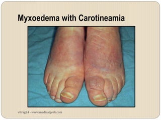 Myxoedema with Carotineamia




vitrag24 - www.medicalgeek.com
 