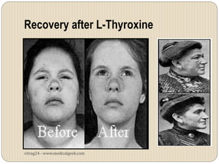Recovery after L-Thyroxine




vitrag24 - www.medicalgeek.com
 