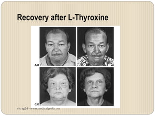 Recovery after L-Thyroxine




vitrag24 - www.medicalgeek.com
 