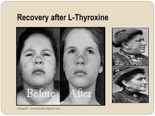 hypothyroidism before and after face