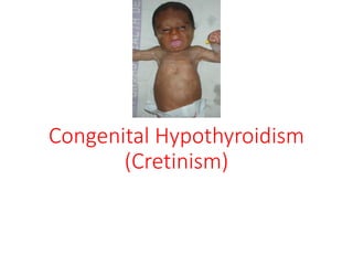 Congenital Hypothyroidism
(Cretinism)
 