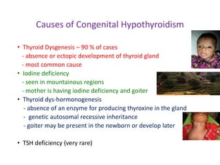 Causes of Congenital Hypothyroidism
• Thyroid Dysgenesis – 90 % of cases
- absence or ectopic development of thyroid gland
- most common cause
• Iodine deficiency
- seen in mountainous regions
- mother is having iodine deficiency and goiter
• Thyroid dys-hormonogenesis
- absence of an enzyme for producing thyroxine in the gland
- genetic autosomal recessive inheritance
- goiter may be present in the newborn or develop later
• TSH deficiency (very rare)
 