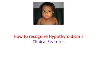 How to recognize Hypothyroidism ?
Clinical Features
 