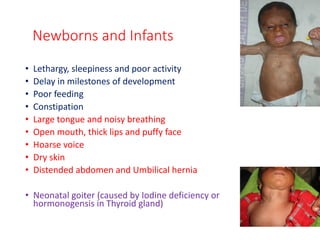 Newborns and Infants
• Lethargy, sleepiness and poor activity
• Delay in milestones of development
• Poor feeding
• Constipation
• Large tongue and noisy breathing
• Open mouth, thick lips and puffy face
• Hoarse voice
• Dry skin
• Distended abdomen and Umbilical hernia
• Neonatal goiter (caused by Iodine deficiency or dys-
hormonogensis in Thyroid gland)
 