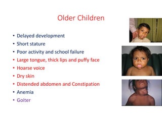 Older Children
• Delayed development
• Short stature
• Poor activity and school failure
• Large tongue, thick lips and puffy face
• Hoarse voice
• Dry skin
• Distended abdomen and Constipation
• Anemia
• Goiter
 