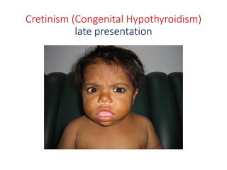 Cretinism (Congenital Hypothyroidism)
late presentation
 