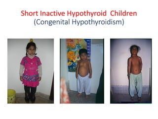 Short Inactive Hypothyroid Children
(Congenital Hypothyroidism)
 