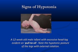 Signs of HypotoniaSigns of Hypotonia
A 12-week-old male infant with excessive head-lagA 12-week-old male infant with excessive head-lag
evident on ‘evident on ‘pull-to-sitpull-to-sit’. Note the hypotonic posture’. Note the hypotonic posture
of the legs with external rotation.of the legs with external rotation.
 