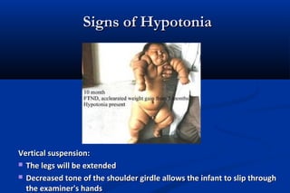 Signs of HypotoniaSigns of Hypotonia
Vertical suspension:Vertical suspension:
 The legs will be extendedThe legs will be extended
 Decreased tone of the shoulder girdle allows the infant to slip throughDecreased tone of the shoulder girdle allows the infant to slip through
the examiner's handsthe examiner's hands
 