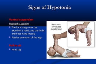 Signs of HypotoniaSigns of Hypotonia
Ventral suspensionVentral suspension
Inverted U positionInverted U position
 The back hangs over theThe back hangs over the
examiner's hand, and the limbsexaminer's hand, and the limbs
and head hang looselyand head hang loosely
 Passive extension of the legsPassive extension of the legs
Pull to sitPull to sit
 Head lagHead lag
 