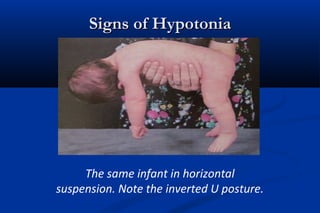 Signs of HypotoniaSigns of Hypotonia
The same infant in horizontal
suspension. Note the inverted U posture.
 