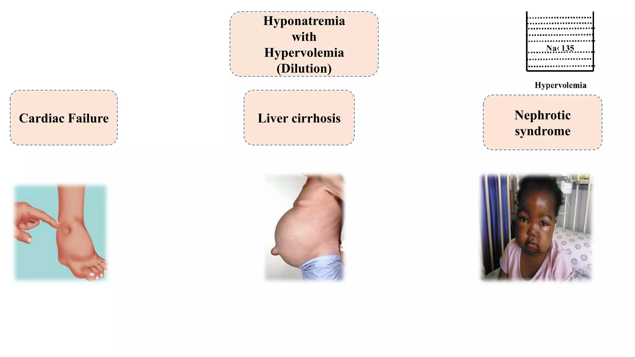 Hypo vs hypernatremia | PPT