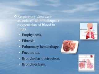 Respiratory disorders
associated with inadequate
oxygenation of blood in
lungs.
• Emphysema.
• Fibrosis.
• Pulmonary hemorrhage.
• Pneumonia.
• Bronchiolar obstruction.
• Bronchiectasis.
 