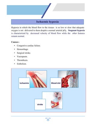 Hypoxia in which the blood flow to the tissues is so low or slow that adequate
oxygen is not delivered to them despite a normal arterial pO2. Stagnant hypoxia
is characterized by decreased velocity of blood flow while the other features
remain normal.
Causes:-
• Congestive cardiac failure.
• Hemorrhage.
• Surgical stroke.
• Vasospasm.
• Thrombosis.
• Embolism.
Ischaemia Blood clot
stroke
Ischaemic hypoxia
 