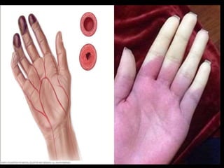 Hypoxemia Rash Hypoxia and its effects | PPTX