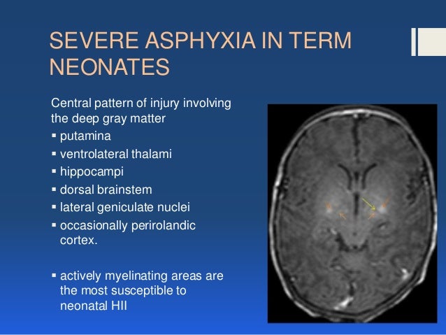 hypoxic ischemic encephalopathy
