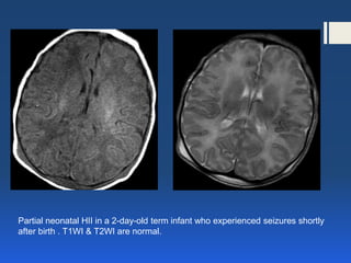 ischemic hypoxic encephalopathy