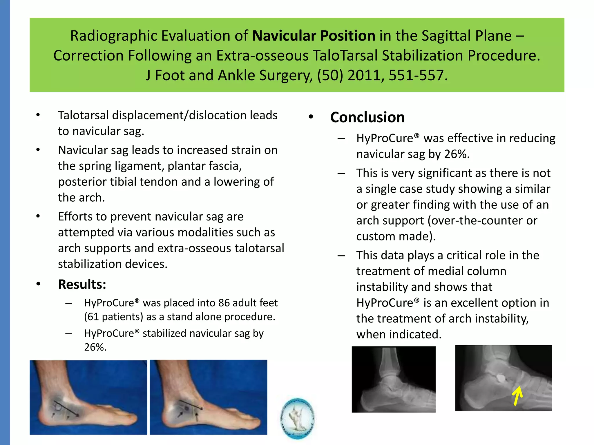 Radiographic Evaluation of Navicular Position in the Sagittal Plane –
Correction Following an Extra-osseous TaloTarsal Stabilization Procedure.
J Foot and Ankle Surgery, (50) 2011, 551-557.
• Talotarsal displacement/dislocation leads
to navicular sag.
• Navicular sag leads to increased strain on
the spring ligament, plantar fascia,
posterior tibial tendon and a lowering of
the arch.
• Efforts to prevent navicular sag are
attempted via various modalities such as
arch supports and extra-osseous talotarsal
stabilization devices.
• Results:
– HyProCure® was placed into 86 adult feet
(61 patients) as a stand alone procedure.
– HyProCure® stabilized navicular sag by
26%.
• Conclusion
– HyProCure® was effective in reducing
navicular sag by 26%.
– This is very significant as there is not
a single case study showing a similar
or greater finding with the use of an
arch support (over-the-counter or
custom made).
– This data plays a critical role in the
treatment of medial column
instability and shows that
HyProCure® is an excellent option in
the treatment of arch instability,
when indicated.
 