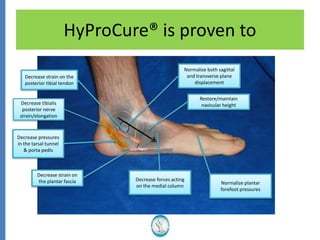 HyProCure® is proven to
Decrease tibialis
posterior nerve
strain/elongation
Decrease pressures
in the tarsal tunnel
& porta pedis
Decrease strain on
the plantar fascia
Decrease strain on the
posterior tibial tendon
Normalize both sagittal
and transverse plane
displacement
Restore/maintain
navicular height
Decrease forces acting
on the medial column
Normalize plantar
forefoot pressures
 