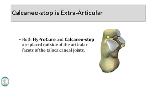 Calcaneo-stop is Extra-Articular
• Both HyProCure and Calcaneo-stop
are placed outside of the articular
facets of the talocalcaneal joints.
 