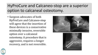 HyProCure and Calcaneo-stop are a superior
option to calcaneal osteotomy.
• Surgeon advocates of both
HyProCure and Calcaneo-stop
will agree that the insertion of
these devices is a conservative
minimally invasive, reversible
option over a calcaneal
osteotomy. A procedure that is
aggressive, requires a longer
recovery, and is not reversible.
 