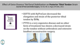Effect of Extra-Osseous TaloTarsal Stabilization on Posterior Tibial Tendon Strain
Journal of Foot and Ankle Surgery, Vol 50, N0. 6, Pages 676-681, 2011
• EOTTS with HyProCure decreased the
elongation and strain of the posterior tibial
tendon by 51%.
• PTTD is a very expensive disease and no other
form of treatment has shown a decreased strain
on the tendon without arthrodesis and extensive
hindfoot reconstructive surgery.
 