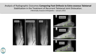 Analysis of Radiographic Outcomes Comparing Foot Orthosis to Extra-osseous Talotarsal
Stabilization in the Treatment of Recurrent Talotarsal Joint Dislocation.
J Minimally Invasive Orthopedics – January 2015
 