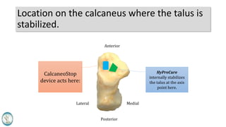 Location on the calcaneus where the talus is
stabilized.
CalcaneoStop
device acts here:
HyProCure
internally stabilizes
the talus at the axis
point here.
Anterior
Posterior
MedialLateral
 