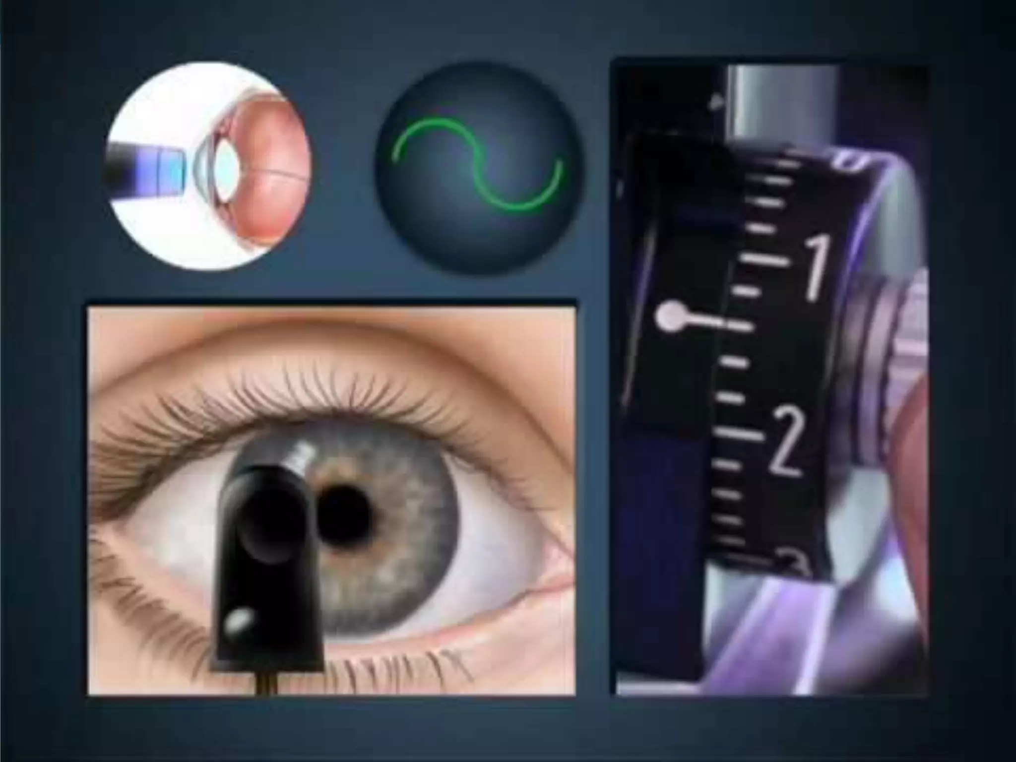 Ophthalmology High yield review