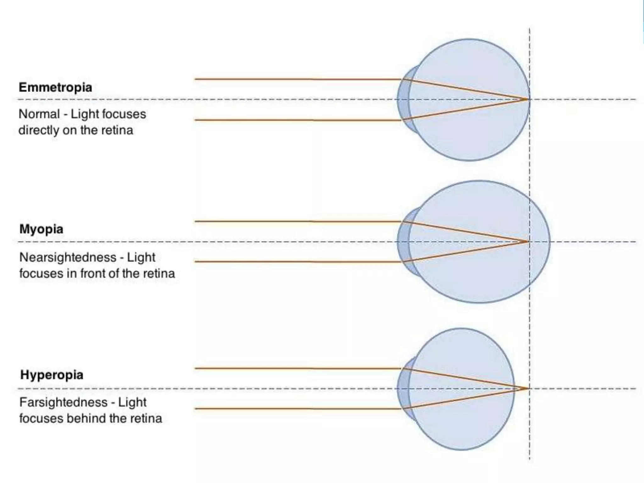 Ophthalmology High yield review