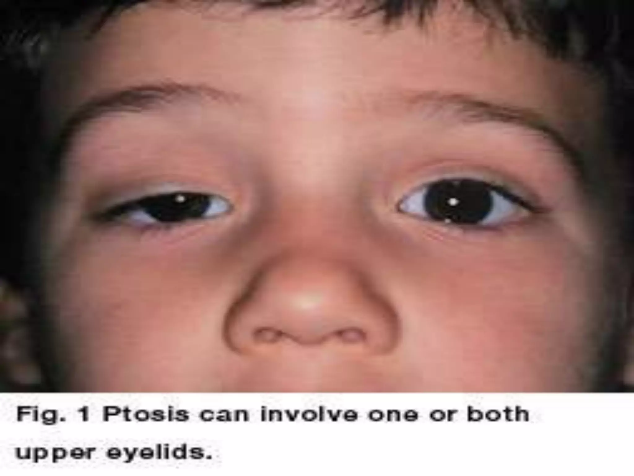 Ophthalmology High yield review