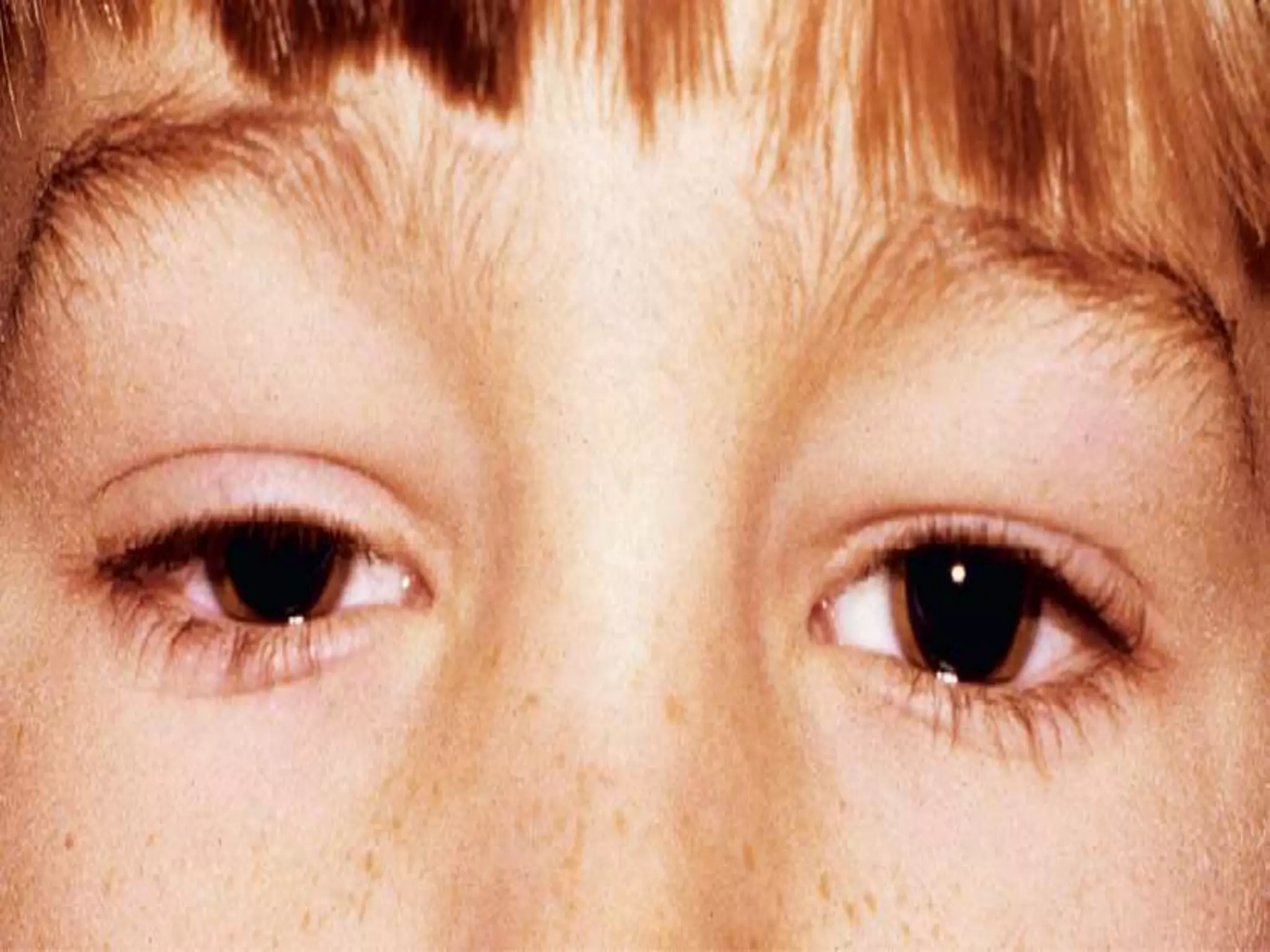 Ophthalmology High yield review