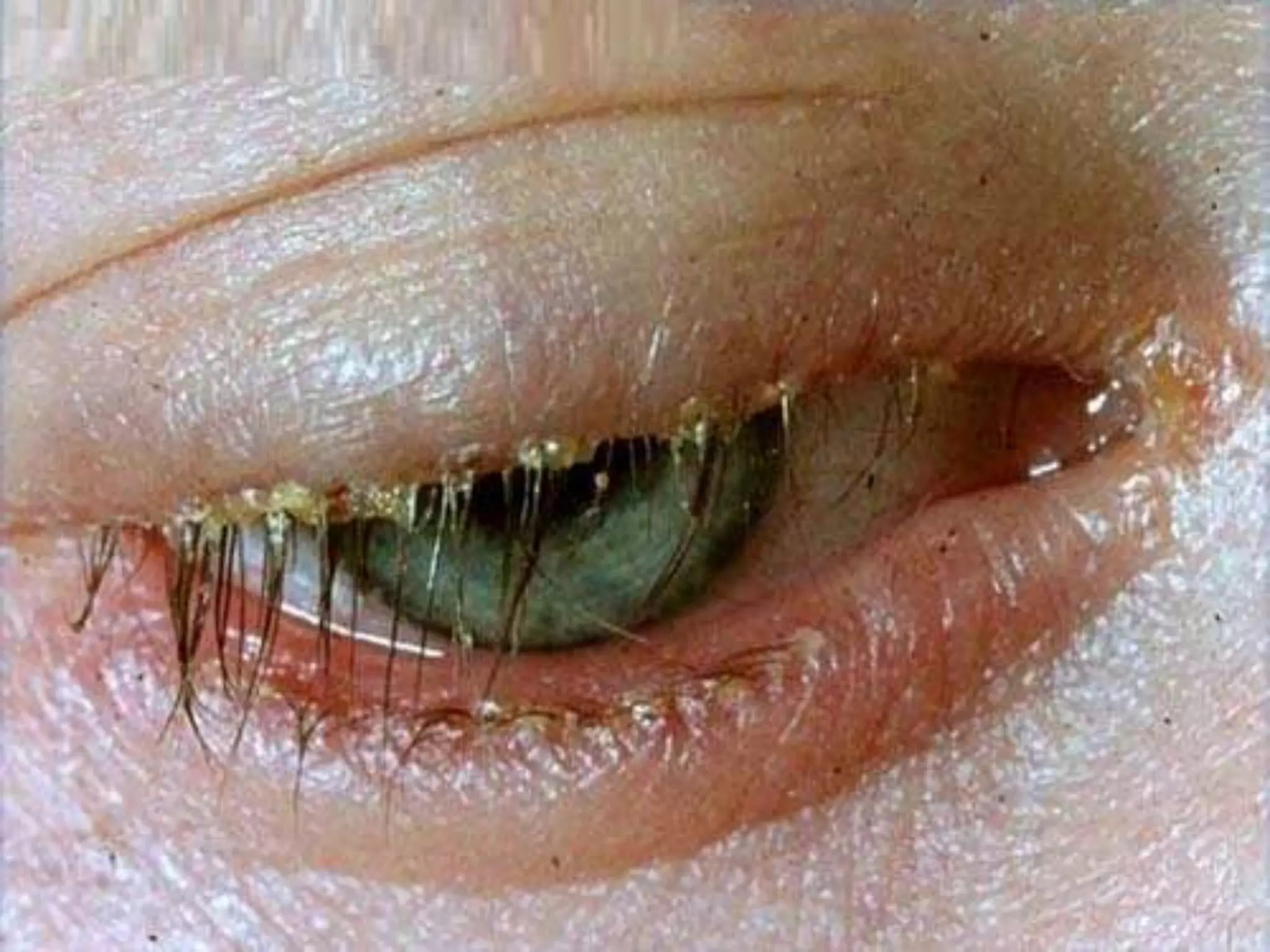 Ophthalmology High yield review