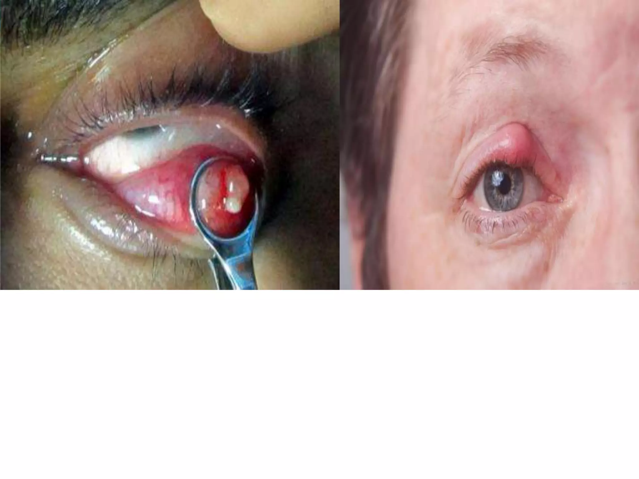 Ophthalmology High yield review