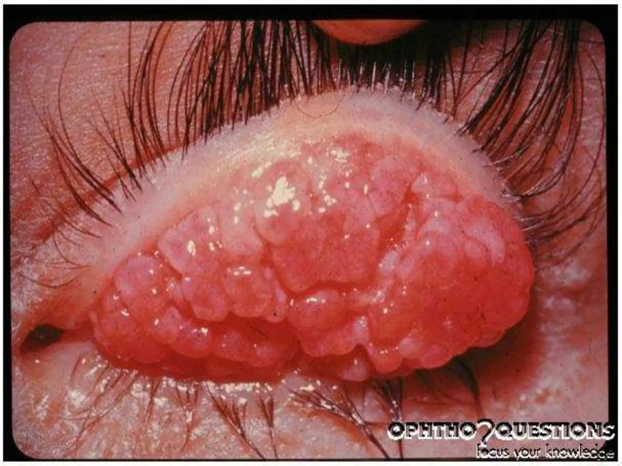 Ophthalmology High yield review