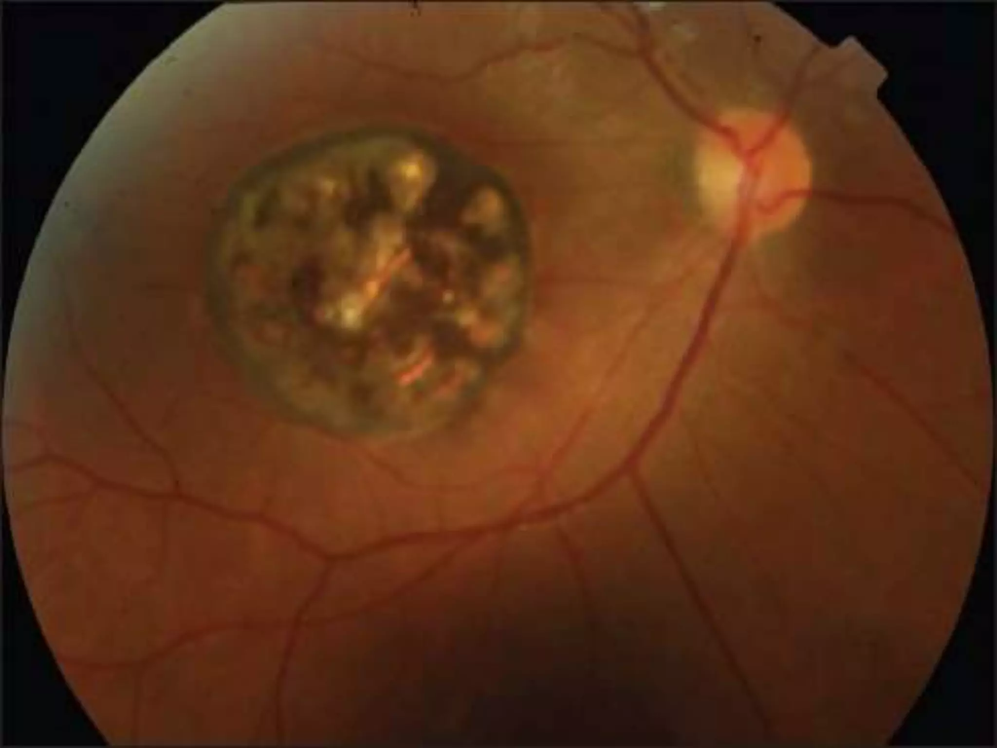 Ophthalmology High yield review