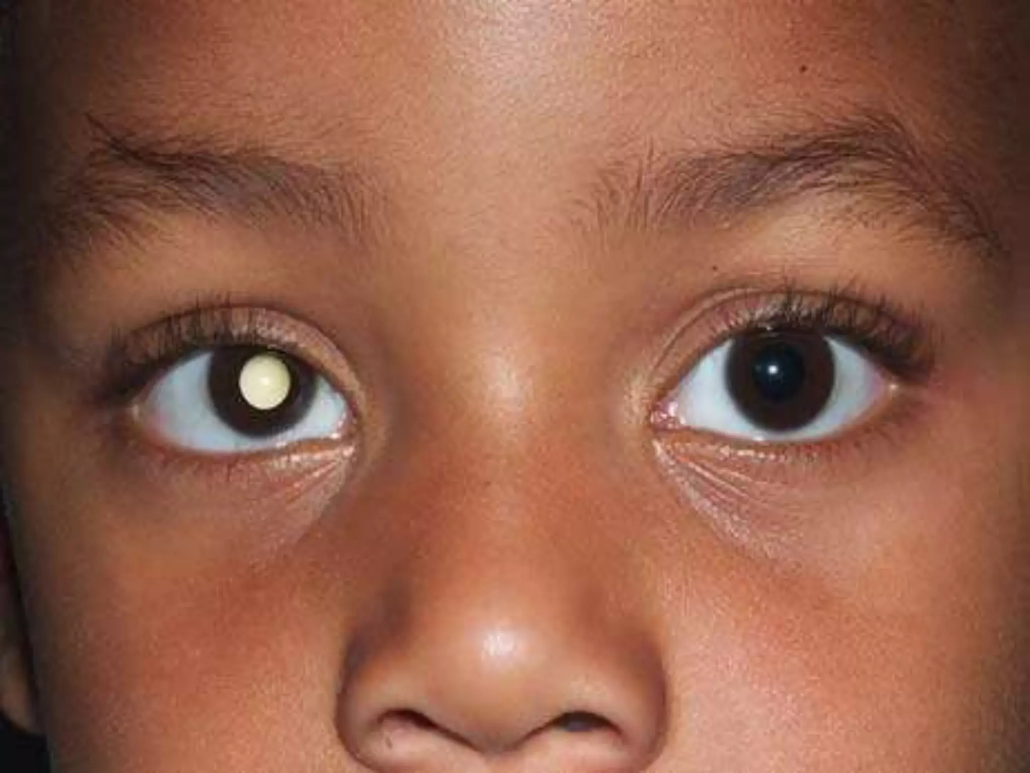 Ophthalmology High yield review