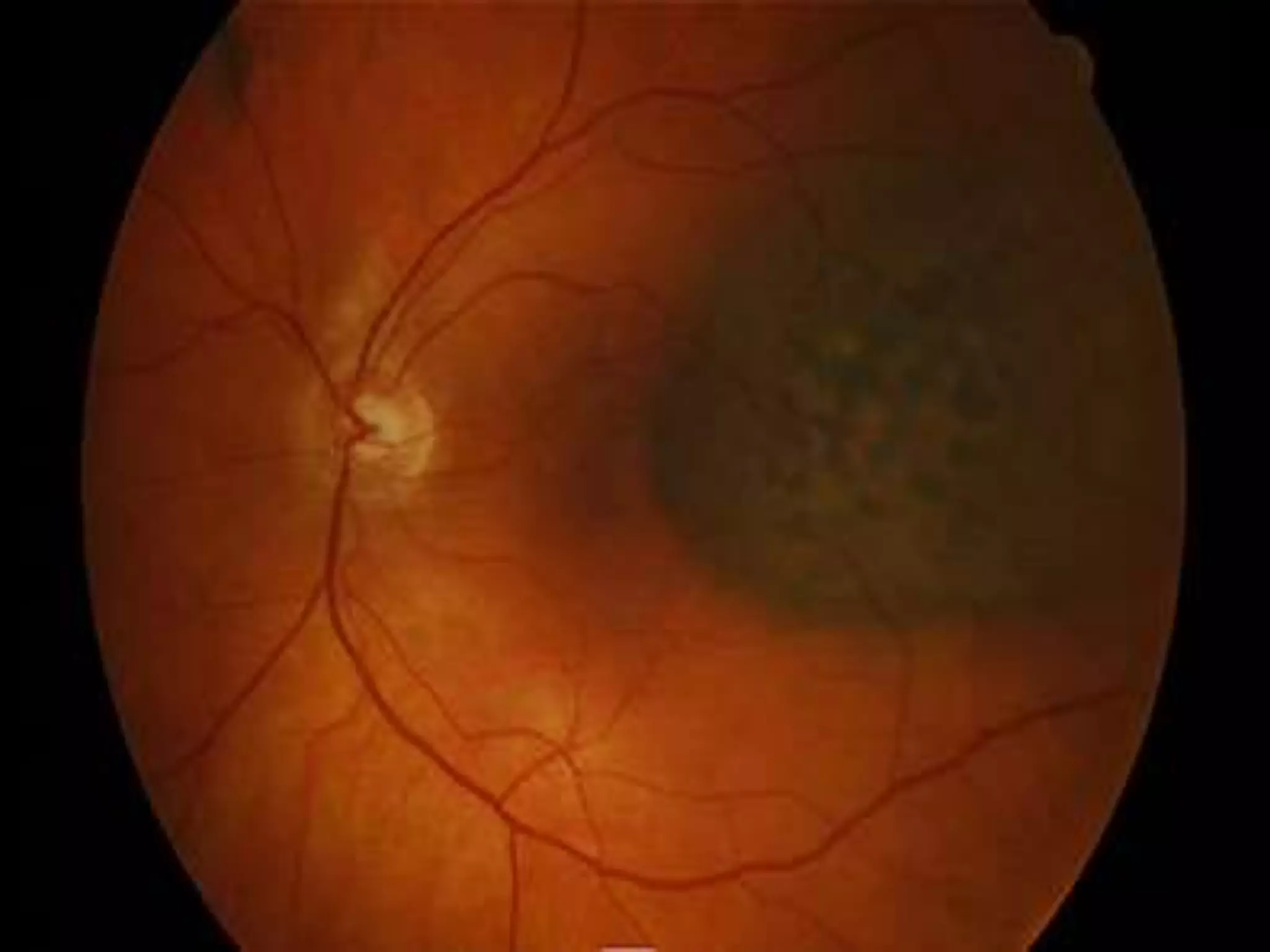 Ophthalmology High yield review