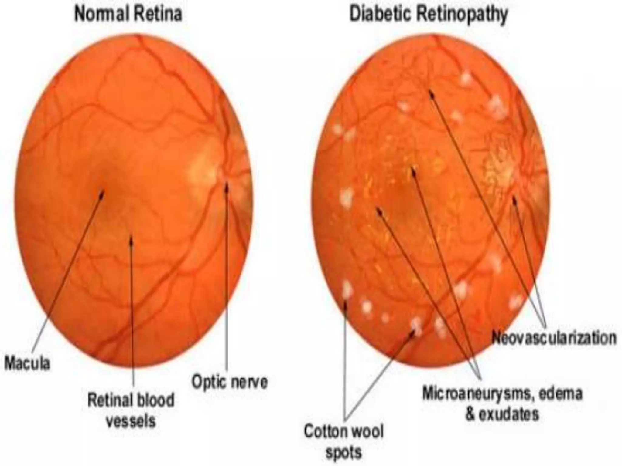 Ophthalmology High yield review