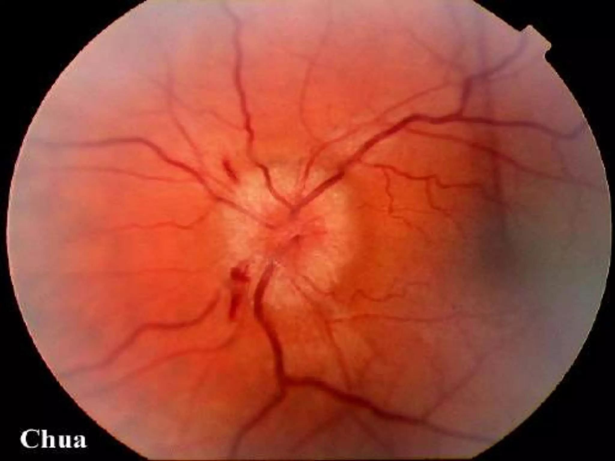 Ophthalmology High yield review