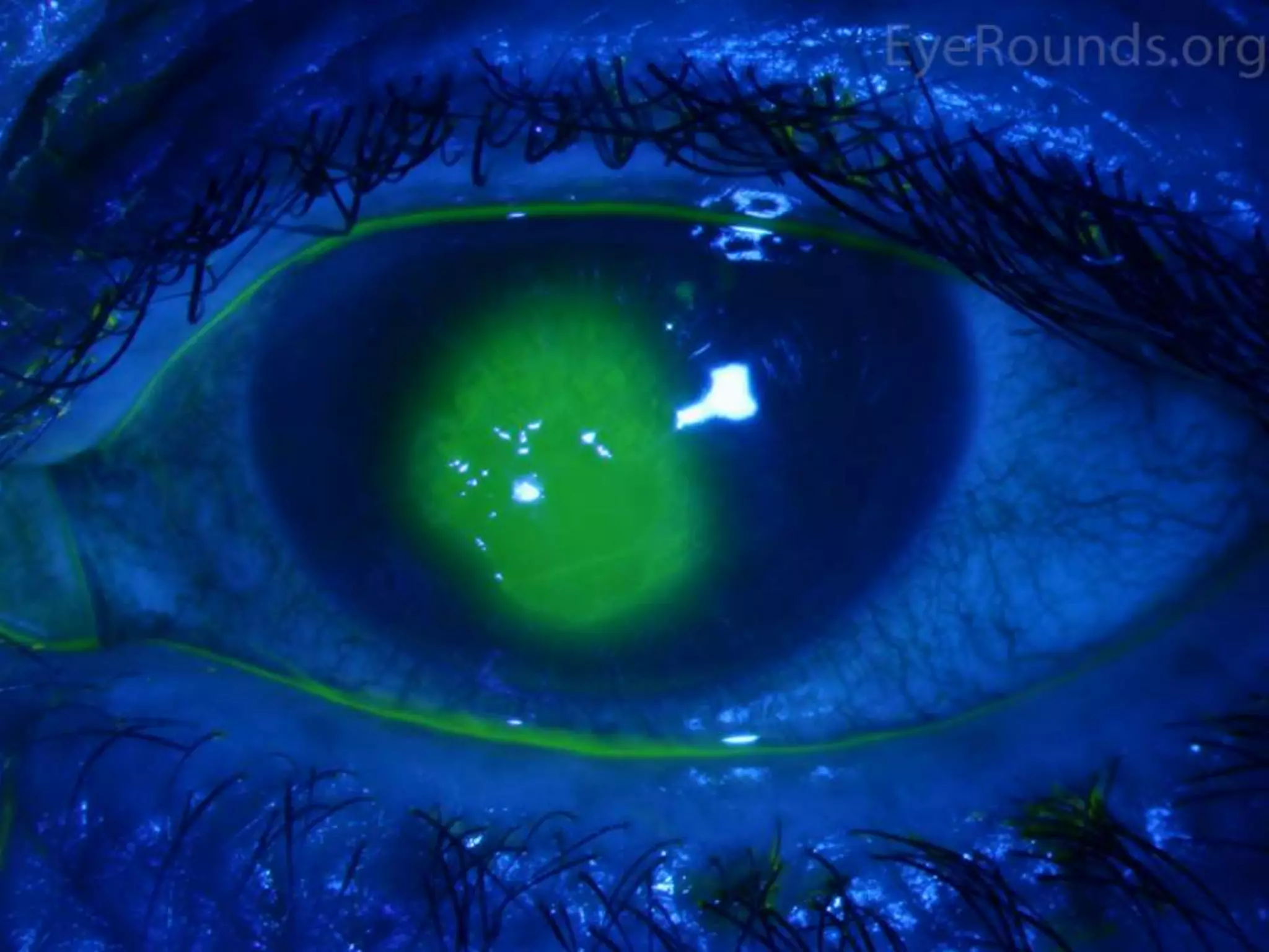 Ophthalmology High yield review