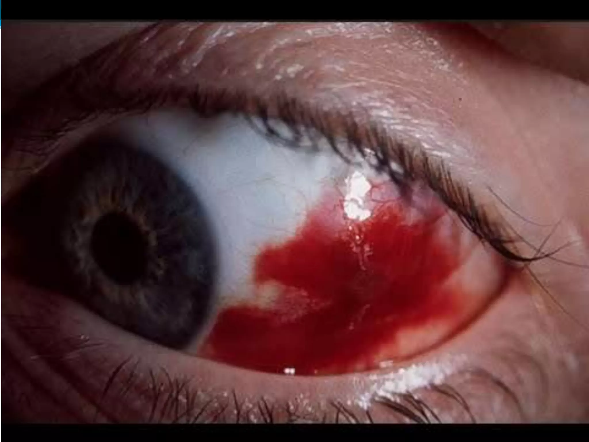 Ophthalmology High yield review