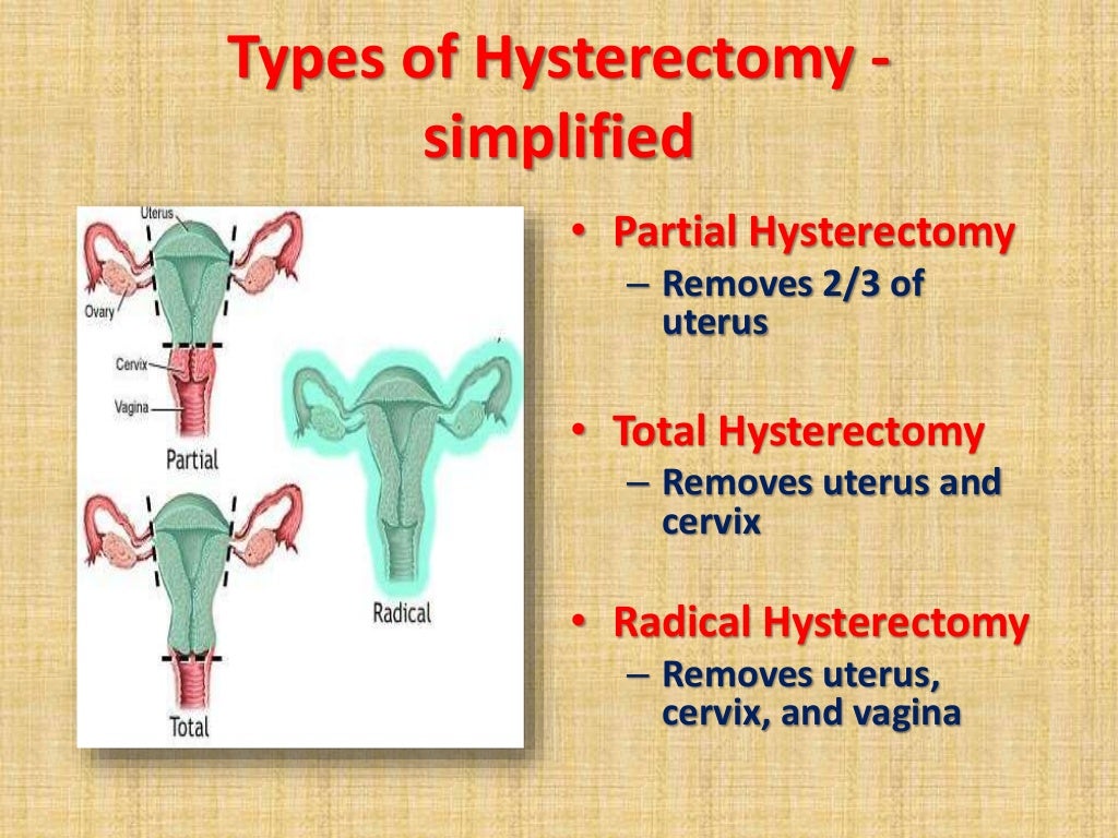 Hysterectomy hysterectomy